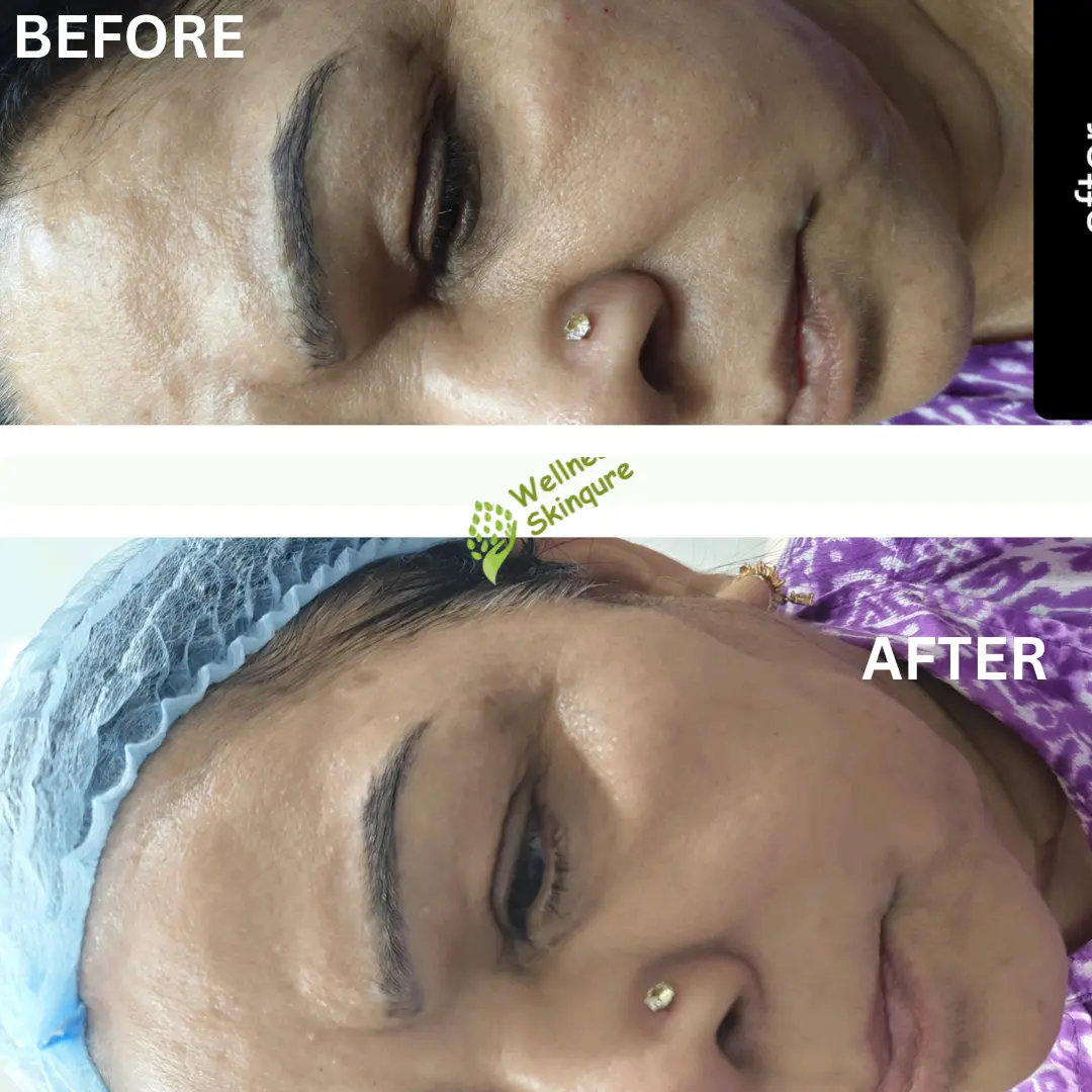 Acne & Acne Scar
